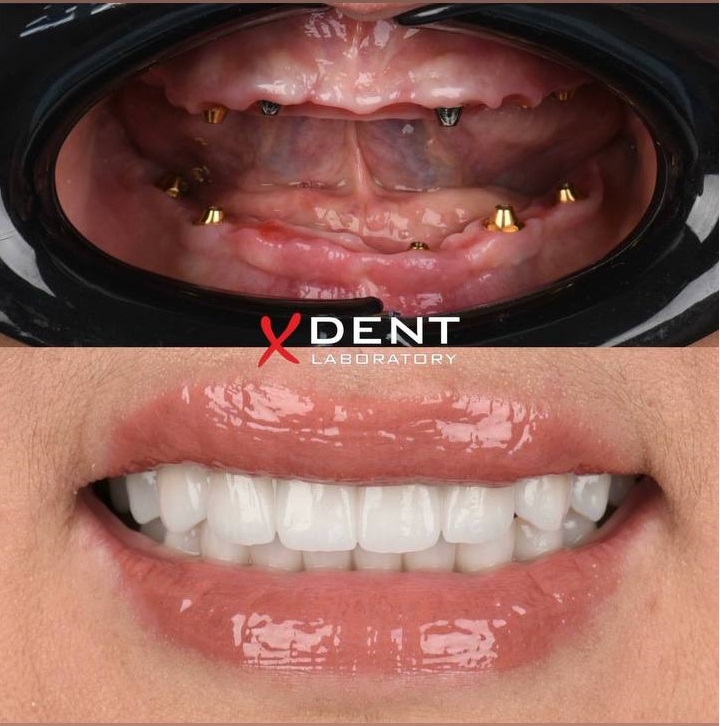 Tish Implantatsiyasi